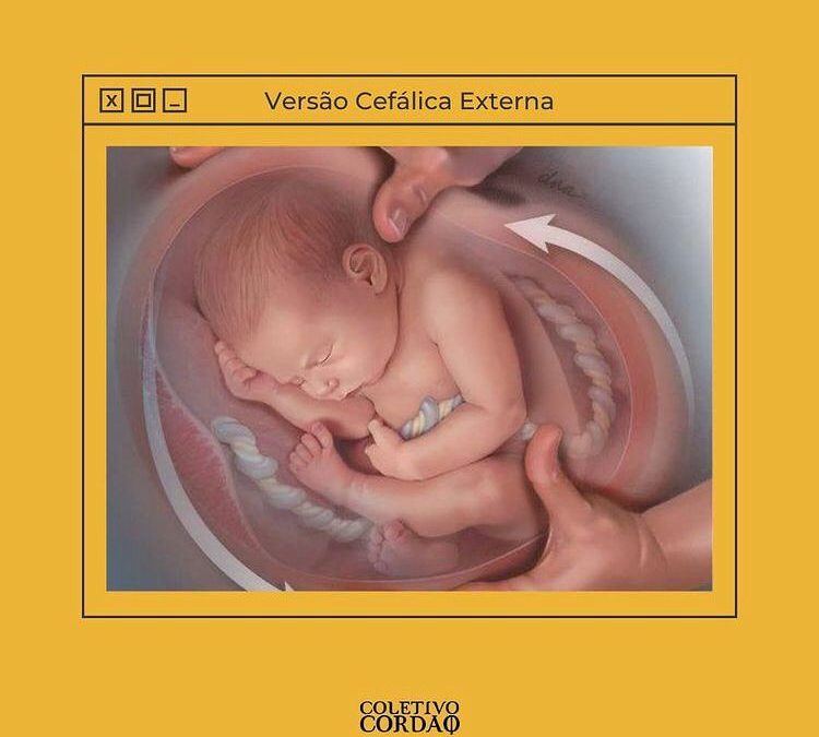 Versão Cefálica Externa